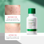 Bioaqua Salicylic Acid Acne Removing Essence Serum