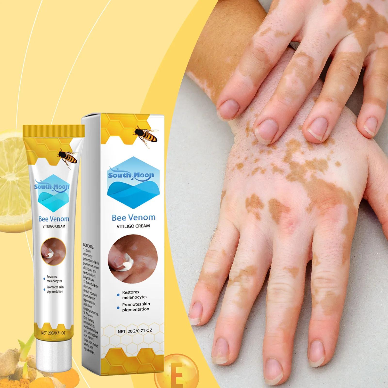 Bee Venom Vitiligo Treatment Cream