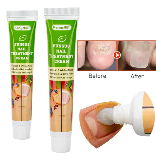 Kanyehb Nail Fungal Treatment Cream