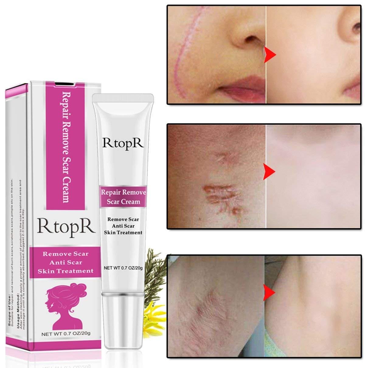 Rtopr Acne Scar Removal Cream