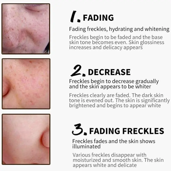 YRFKT Face Brightening Freckles Cream
