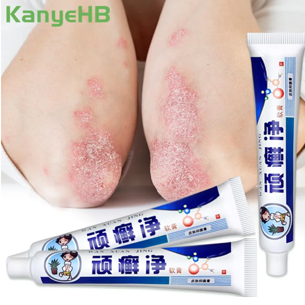 kanyehb Body Anti Psoriasis Cream