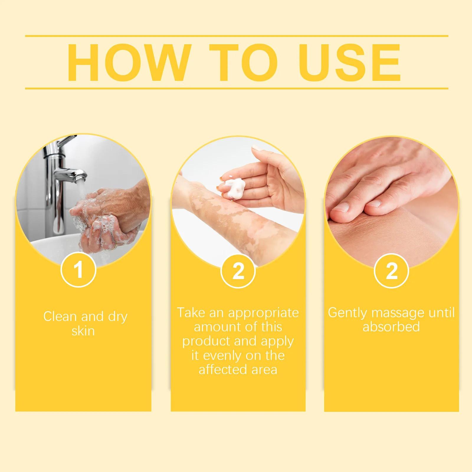 Bee Venom Vitiligo Treatment Cream